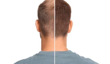 Choosing Between FUT And FUE Hair Transplant Methods
