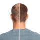 Choosing Between FUT And FUE Hair Transplant Methods