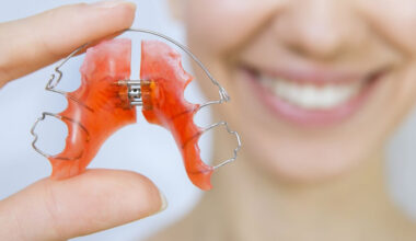How Upper Jaw Expanders Help Correct Narrow Palates Early in South Riding