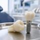 7 Leading Providers For Full Mouth Dental Implants In Tampa